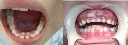 孩子牙齿不齐需要矫正吗,孩子牙齿不齐矫正有必要吗