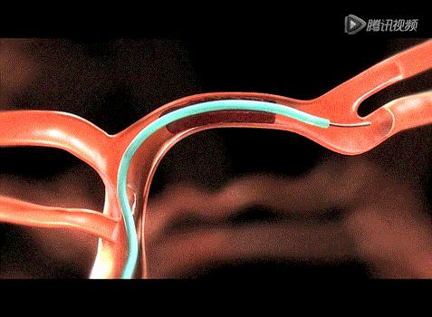 脑血管的清道夫——神奇取栓术