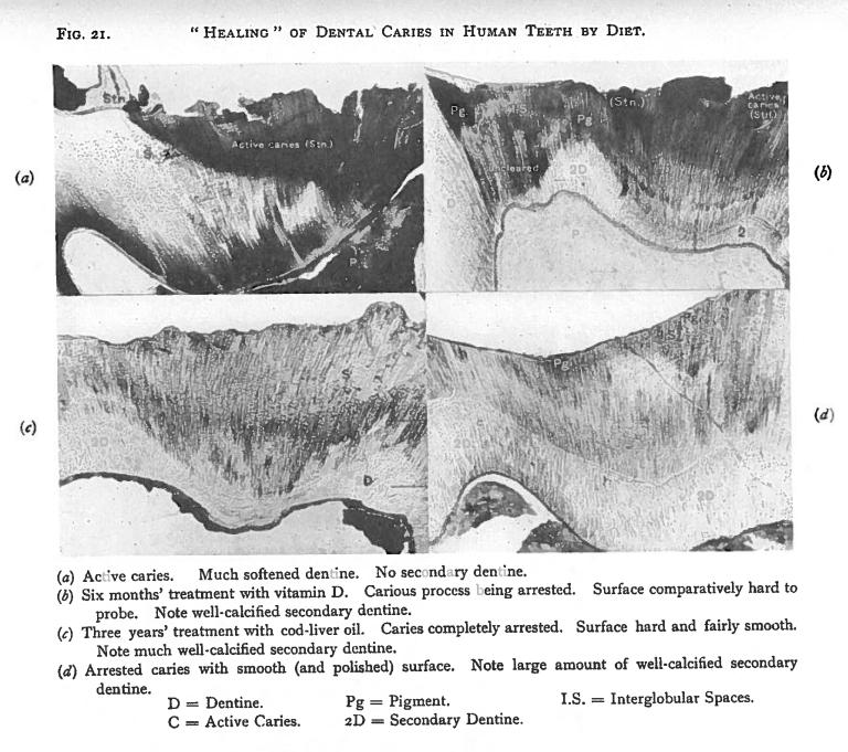 怎么改善蛀牙,怎样治疗牙齿痛和蛀牙