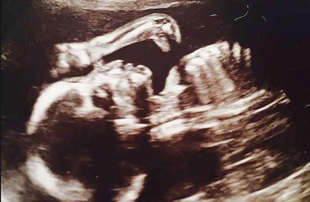 孕妇做b超胎儿在开车视频,b超胎儿开车