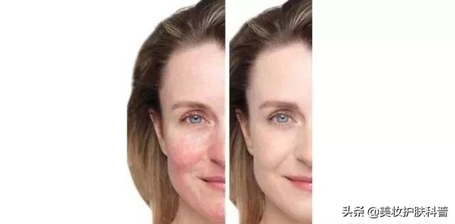 皮肤有血丝有点红怎么修复,红血丝养肤