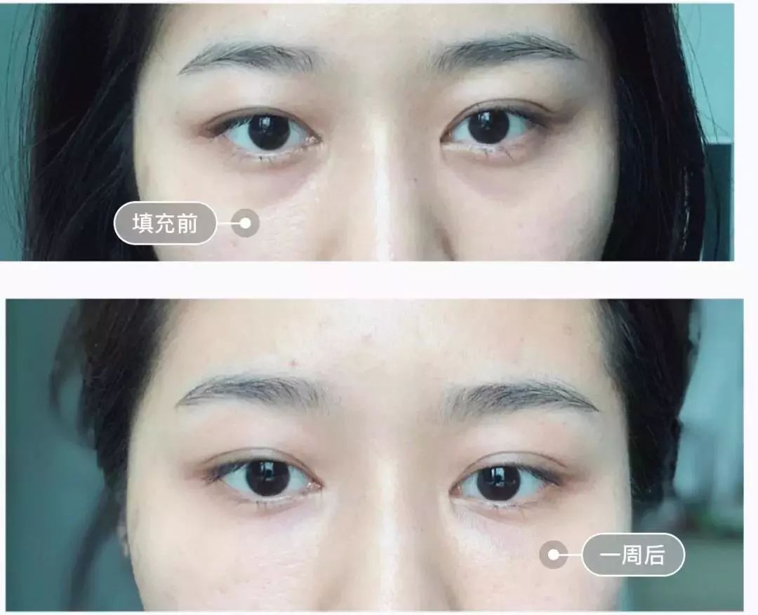 正确认识一下玻尿酸到底有啥功效,请收好这篇玻尿酸全面科普文章