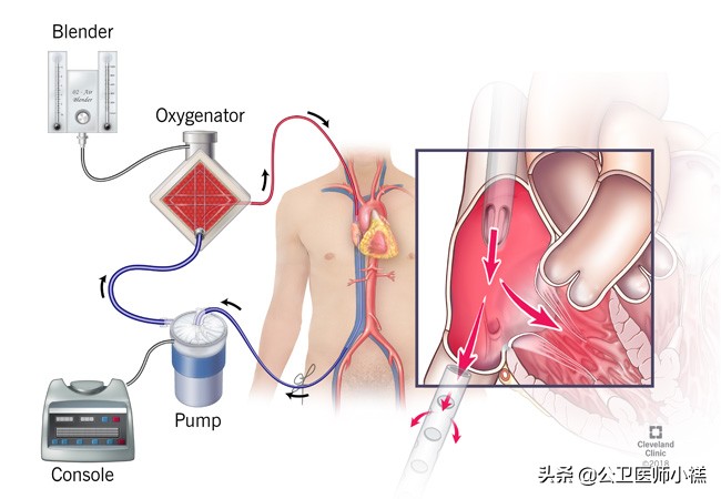 新型冠状病毒感染的肺炎患者肺部影像学改变