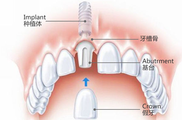 种植牙的知识你知道几个,咨询一下做种植牙全过程