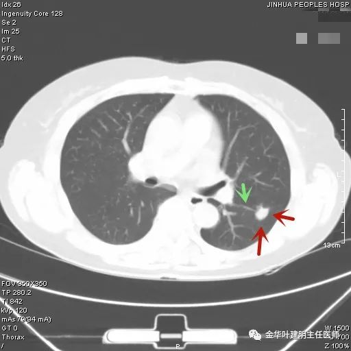 叶建明谈胸膜下的实性结节,叶建明肺实性良性结节会变癌症吗
