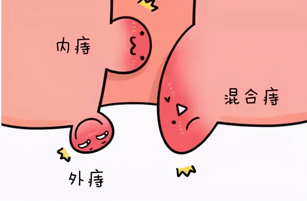 肛裂和没肛裂的区别,肛裂和痔疮不手术可以吗