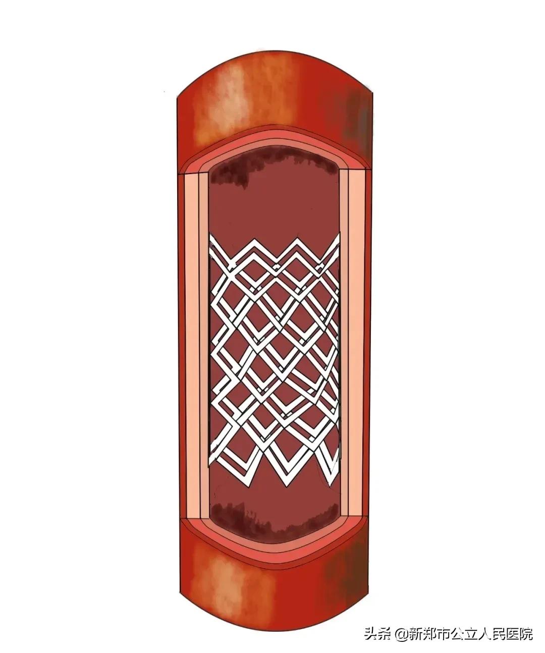 冠脉造影科普宣讲,冠脉CT血管造影