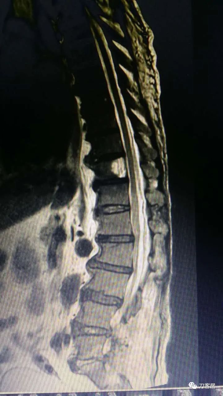 腰椎手术切掉棘突,腰突微创后出血肿
