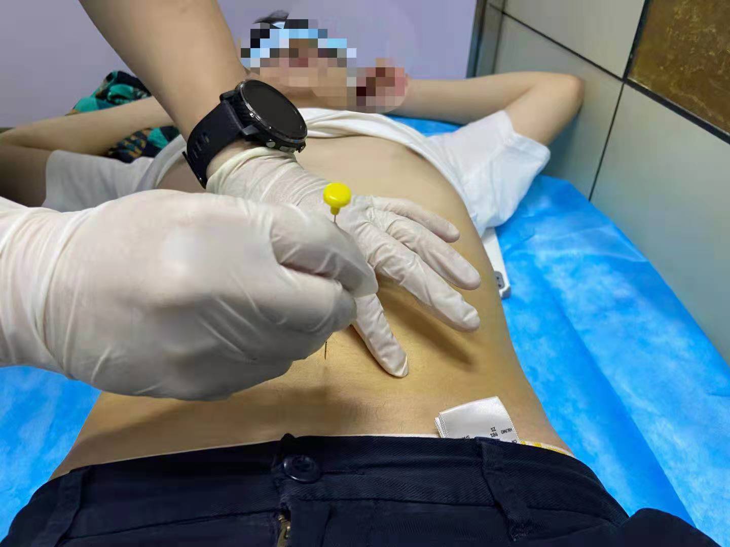 穴位埋线减肥一斤不减,穴位埋线减肥效果如何