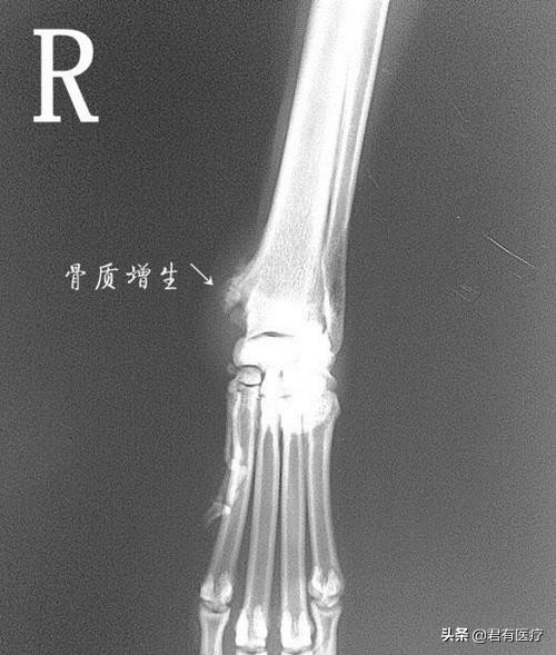 骨科张医生骨质增生,骨科赵医生骨质增生