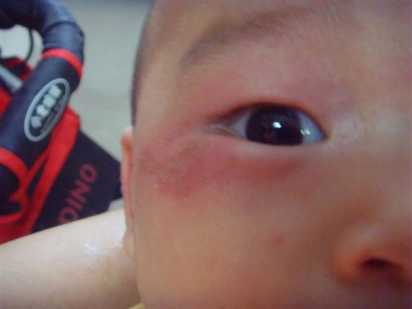 小孩不小心撞到脸怎么办,孩子不小心撞到头怎么办