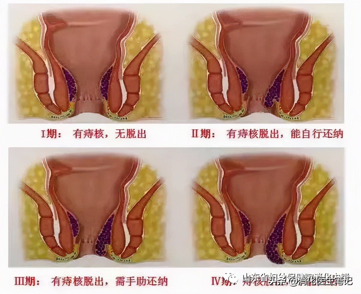 痔疮内痔微创治疗3d演示,痔疮内痔不开刀吃药能根除吗