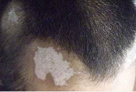 10澶氬勾鐨勭櫧鐧滈鎱㈡參澶嶈壊,绐佺劧澶ч潰绉垎鍙戠櫧鐧滈