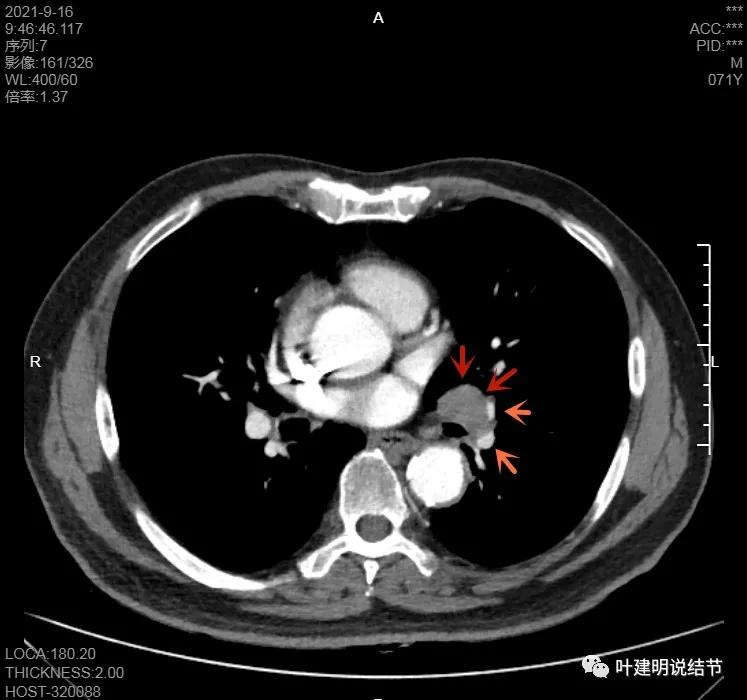 肺上有实性结节6mmx5mm是什么原因,肺上有1.7x1.8的实性结节该怎么办