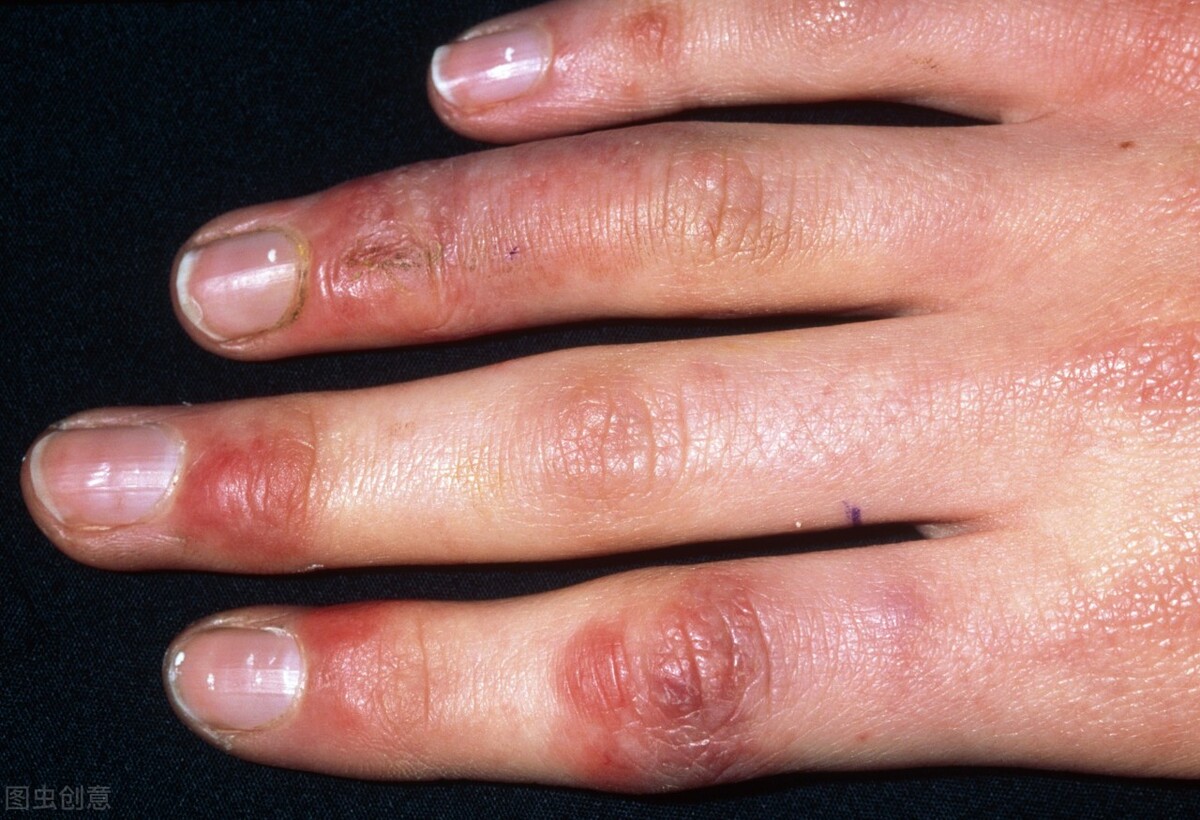 在长冻疮之前手指冻僵了,冬天手冻疮戴手套也没有用怎么办