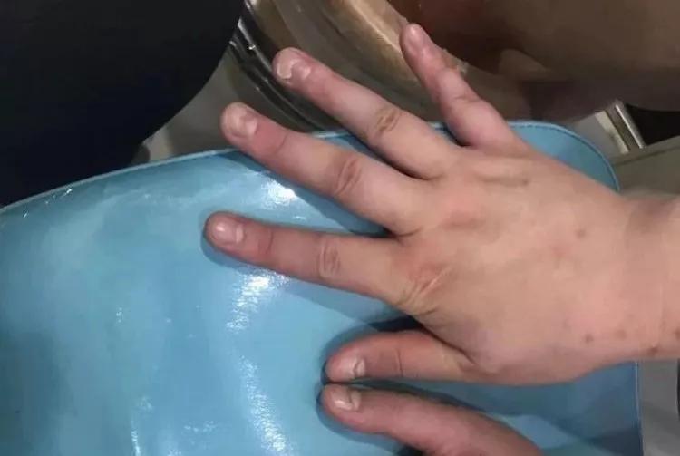 指甲月牙少有白点,指甲月牙消失有竖纹是怎么回事