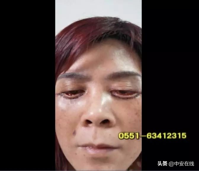安徽巢湖：宾馆里做美容手术致眼睛无法闭合医生身份成谜