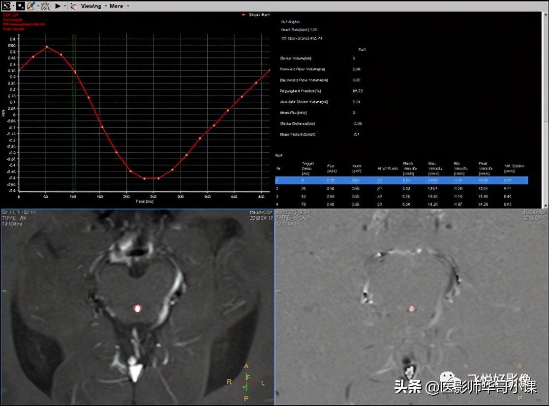 飞利浦磁共振快速扫描方案指南,飞利浦1.5t磁共振各部位扫描技术