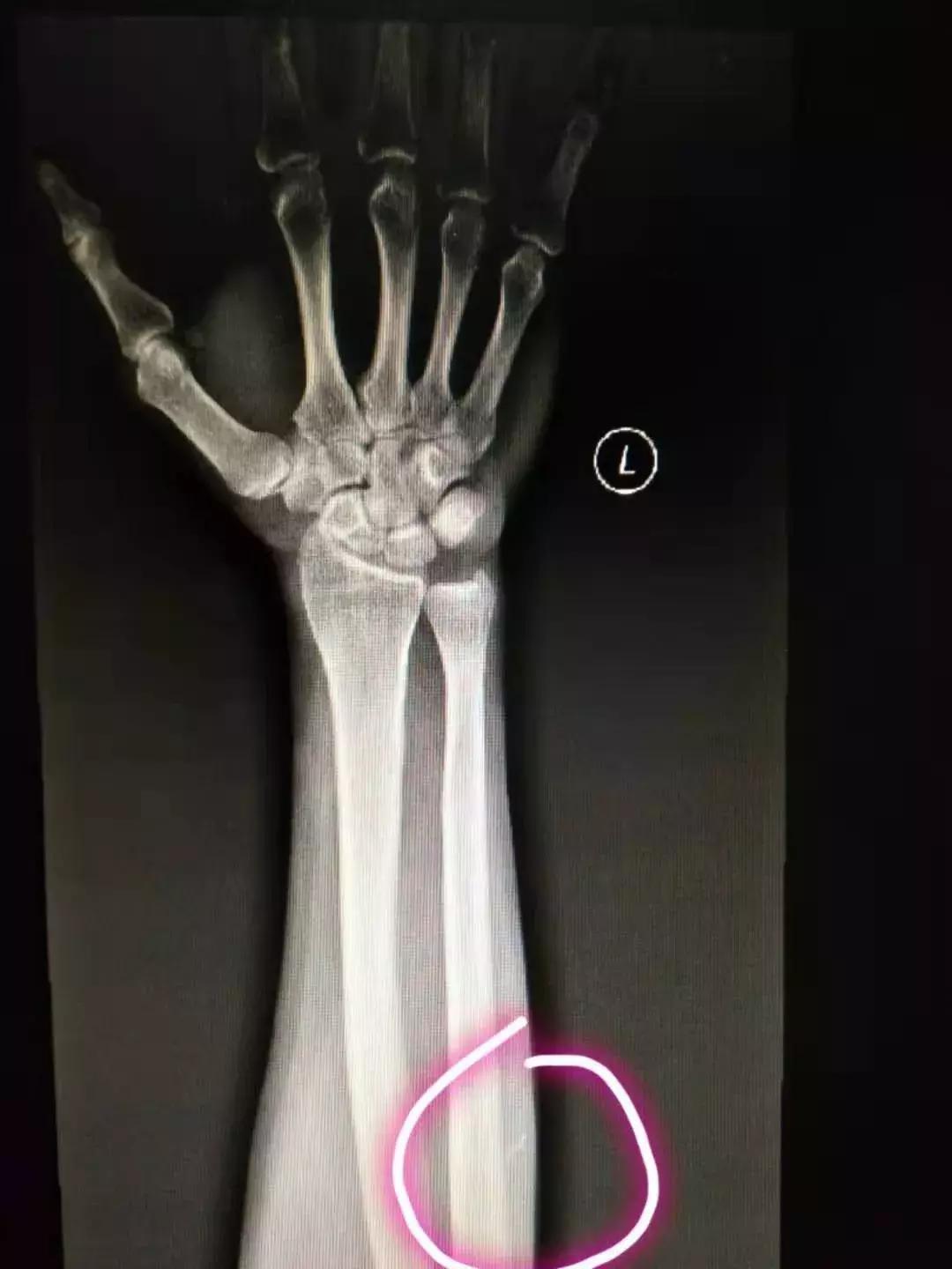 留置针导管会折断血管吗,留置针导管会折断吗