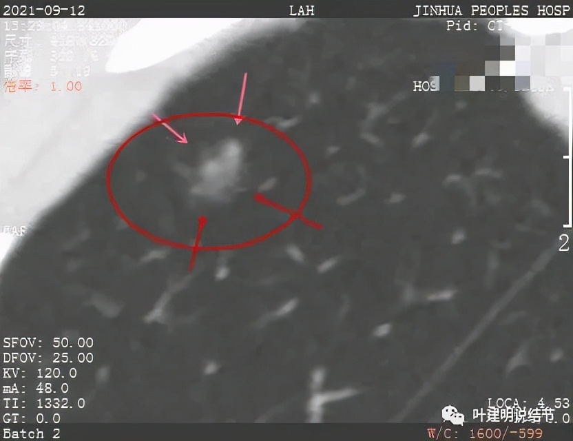 怎样从病理报告看是不是原位癌,原位腺癌切除子宫要开刀吗