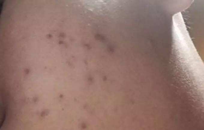 黑痘印与红痘印区别,深色痘印和红色痘印区别