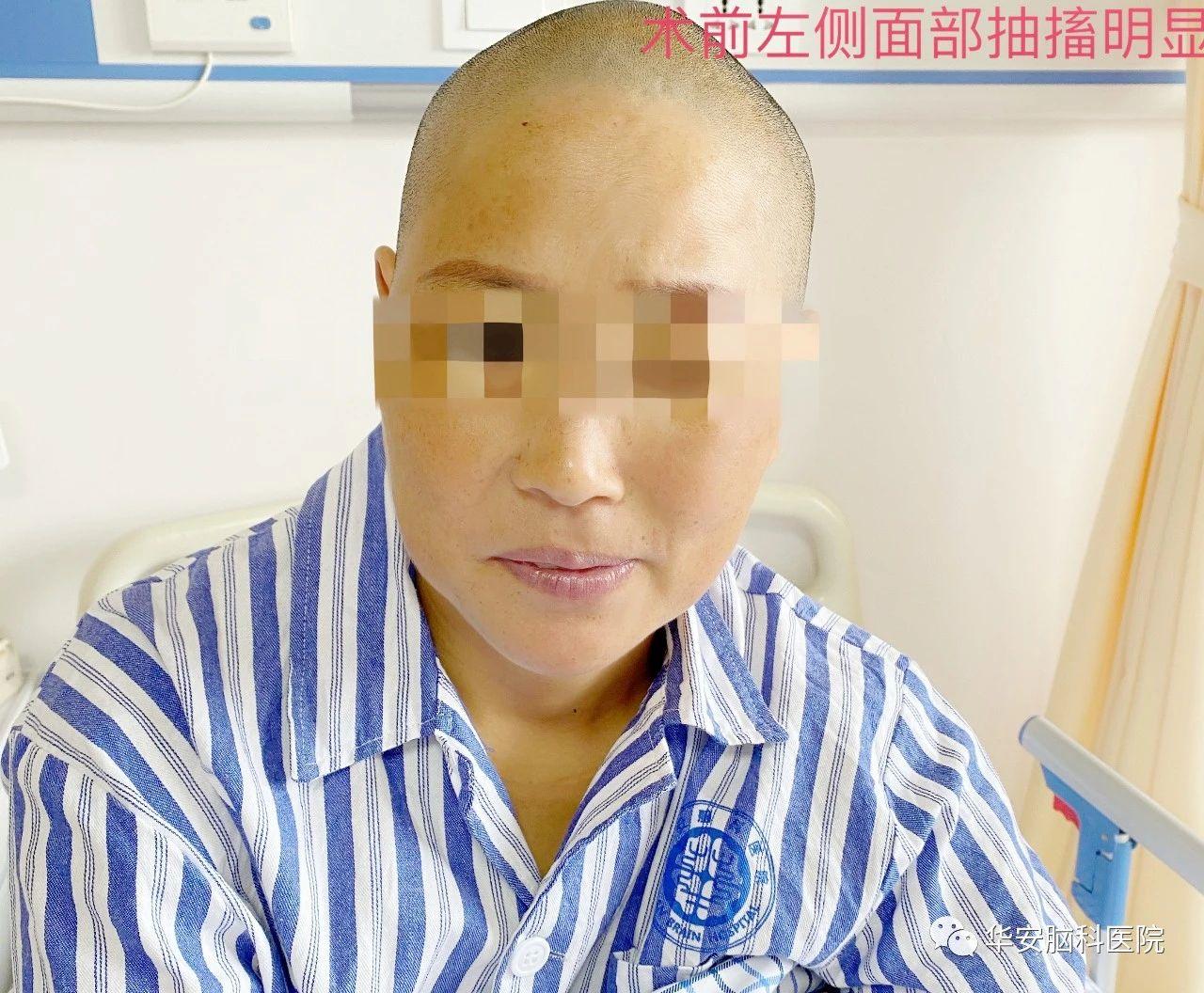 面神经显微血管减压手术,面肌痉挛显微减压术