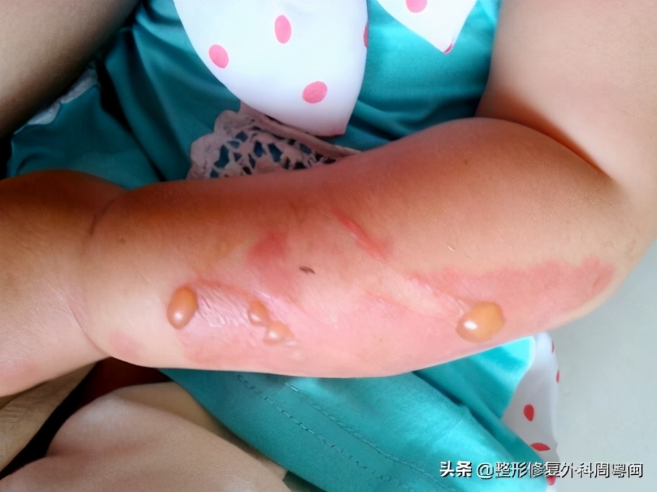 烧烫伤后如何止痒,烧烫伤后的局部处理