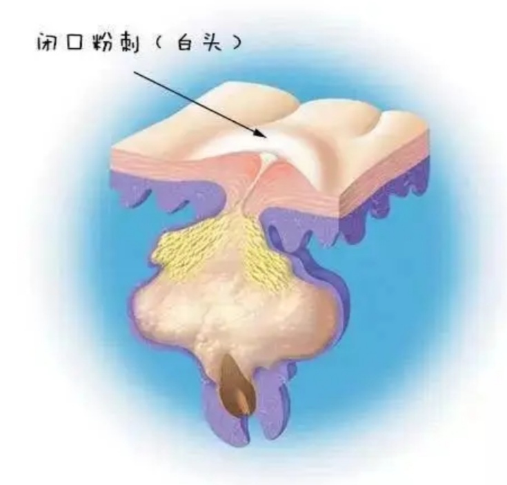 皮脂腺怎么处理,皮脂腺大怎么办