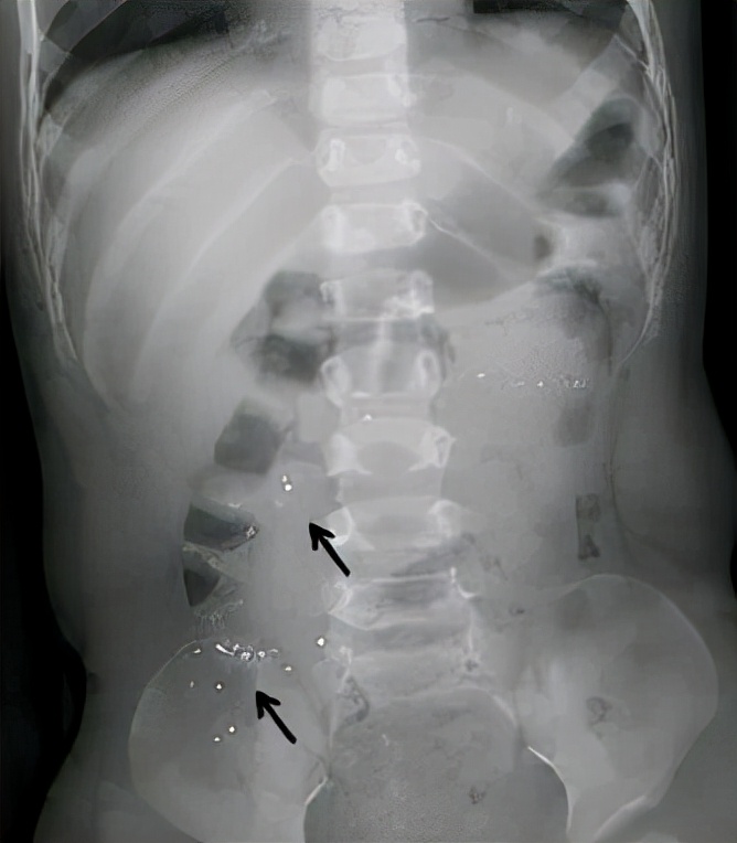 小孩咬破了水银体温计头要催吐不,小孩把体温计咬破咽了水银怎么办
