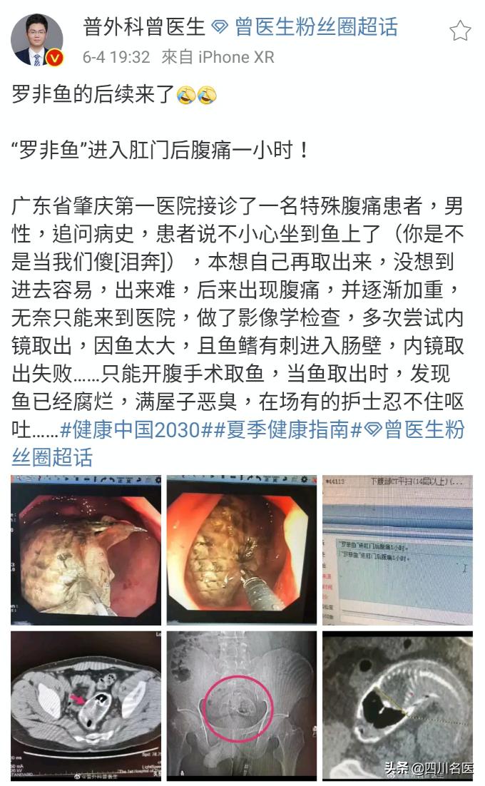 一条罗非鱼“游”进肛门？医生：直肠不直，进去容易出来难