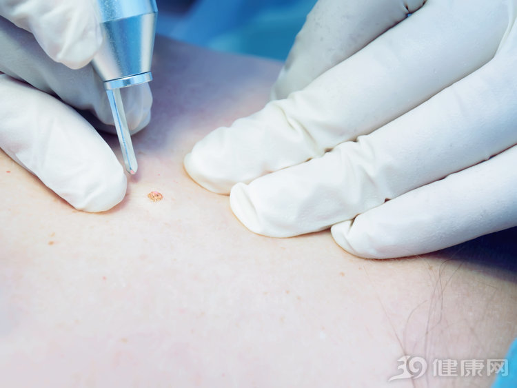 点痣可以阻止癌变吗,女孩点痣好了后面还会复发吗