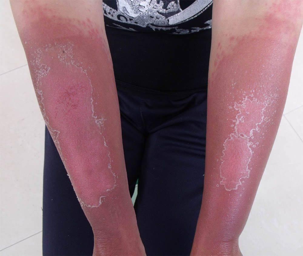 放疗和化疗的区别哪个更严重,放疗化疗是什么两者之间有何不同