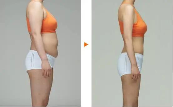 小腿粗壮弯曲不直是什么原因,小腿太粗是经常跑步的原因吗