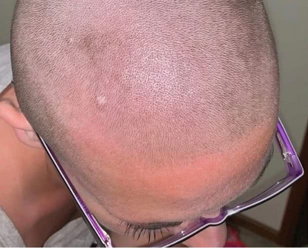 某大牌洗发水中被混入脱毛膏,女子用完头发全掉光