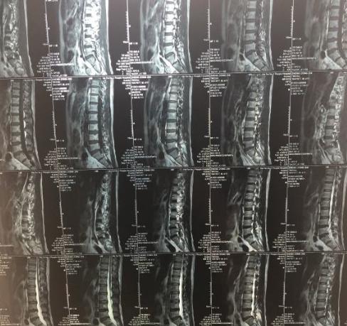 腰椎间盘突出手术后的饮食,术后伤口愈合期间饮食注意事项