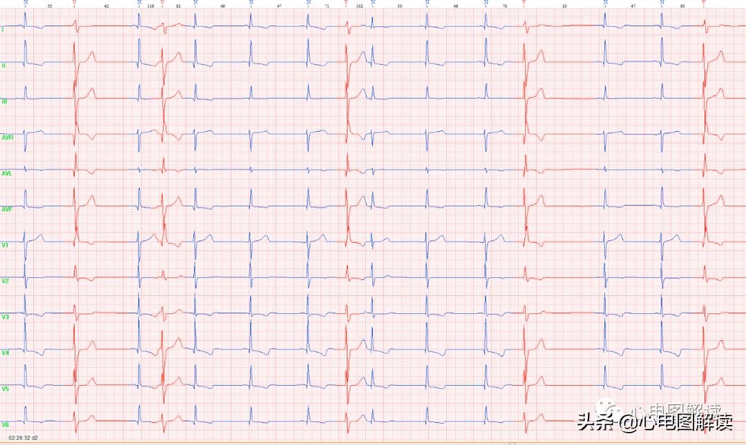 窦性并行心律是心悸吗,窦性心律室性并行心律严重吗