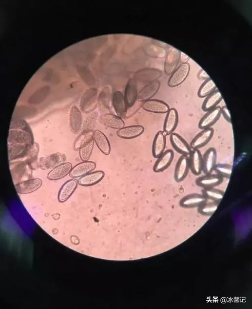 6岁女童蛲虫最简单有效的治法,孩子蛲虫痒怎么快速止痒