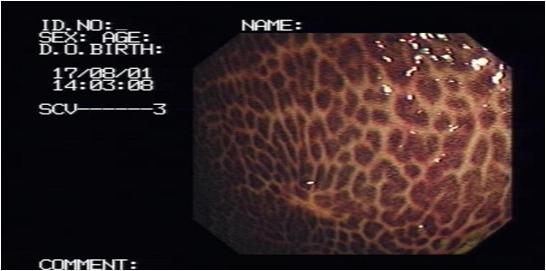 大便不规律的危害,大便不正常一般是肠道什么问题