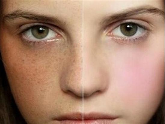 专家快速祛斑妙招推荐视频,皮肤科医生美白祛斑妙招