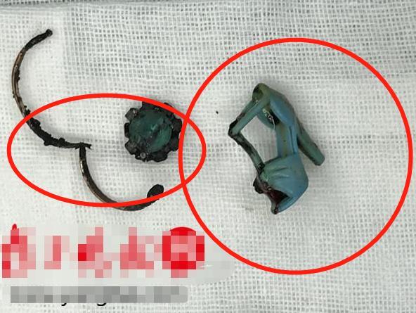 男孩误吞无线耳机,7岁男孩吞耳机