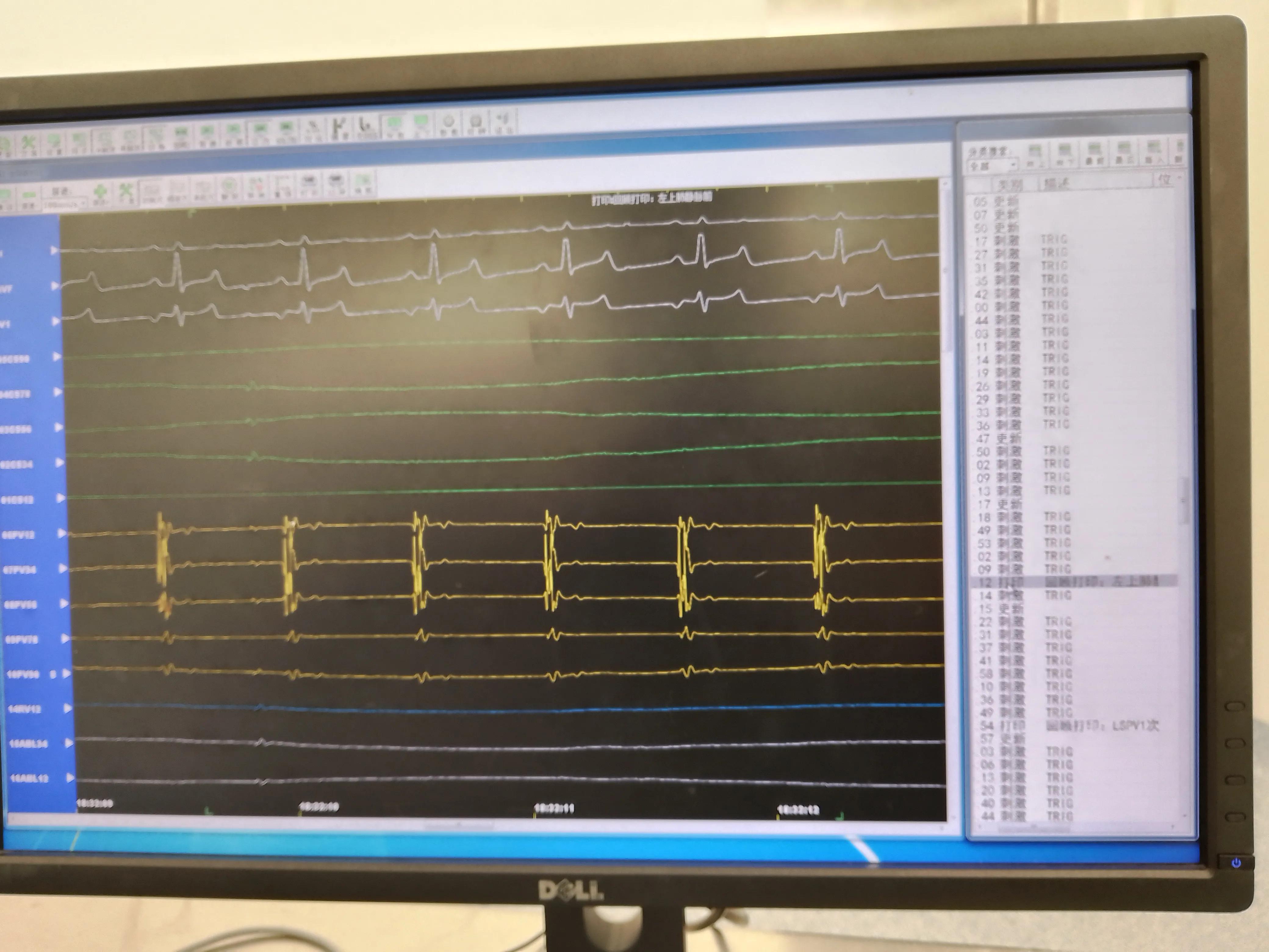 房颤射频消融术器械有哪些,脉冲消融治疗房颤品牌