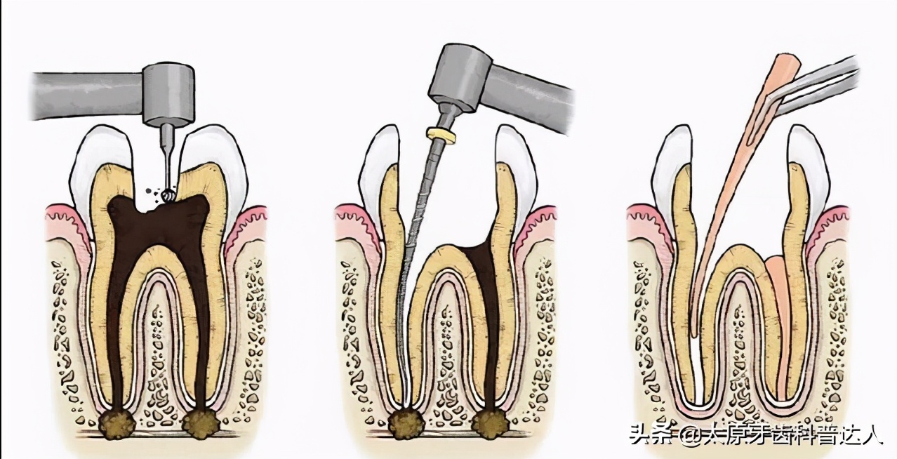 根管治疗几天换次药,牙齿做根管治疗5次了还疼