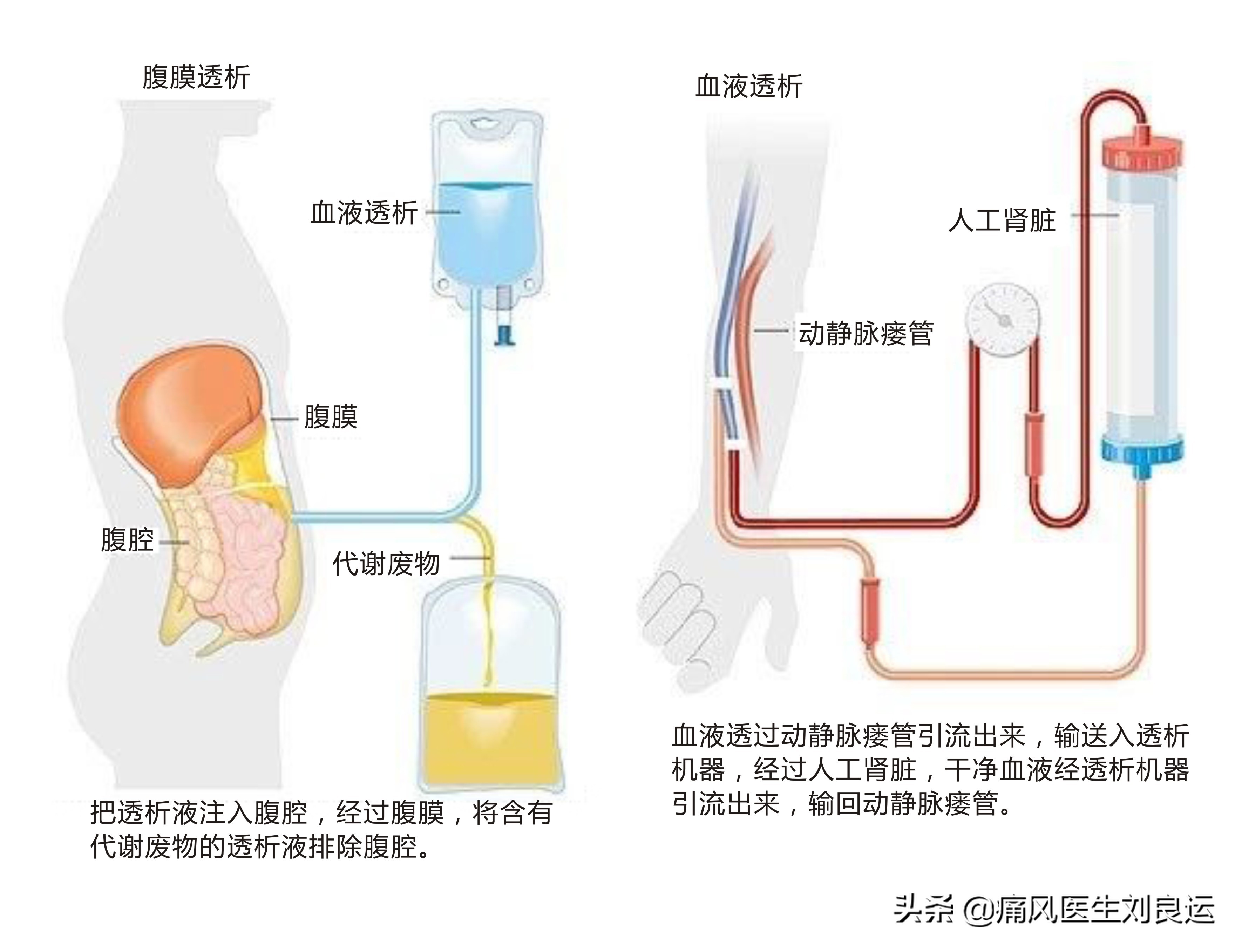 痛风医生建议不手术治疗,痛风尿酸高医生说不用吃药多喝水