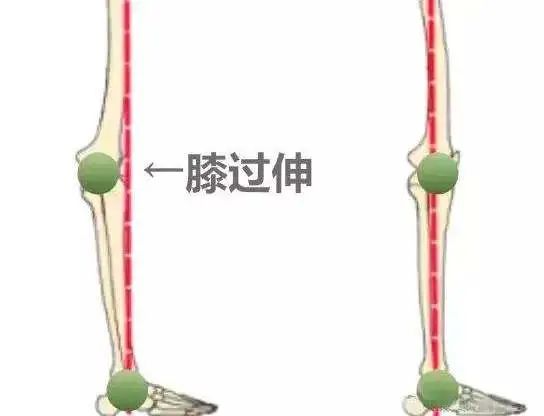 膝超伸腿粗运动可以改善吗,大粗腿膝超伸矫正方法图解