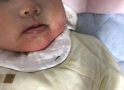 婴儿湿疹来袭，妈妈们要知道的8大应对措施这里都全了