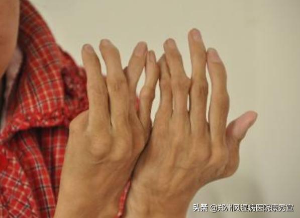 20岁得了类风湿还能活多久,20岁怎么会有类风湿