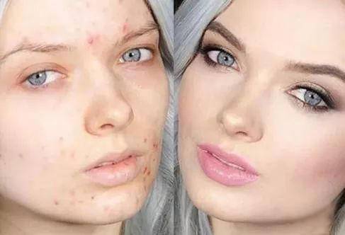 挤痘痘后怎么预防颅内感染,女孩挤痘引发颅内感染新闻