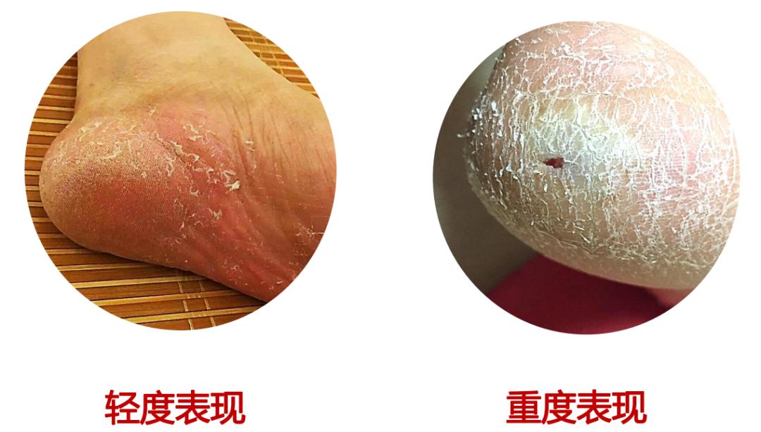 家里治脚气最好的方法,家庭治脚气的最好方法