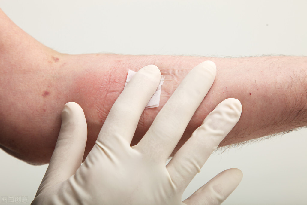 抽血后淤青变紫是扎针的原因吗,抽血后手臂淤青与护士扎针有关吗