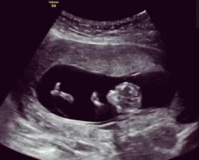 胎儿哪个时间段胎动最频繁,24周双胞胎胎动一个好静一个好动